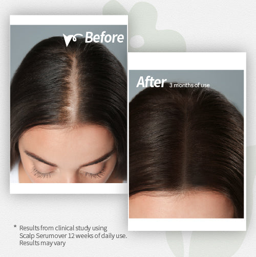 Fast Stop Hair Loss: How Dorpang Scalp Serum Delivers Real Results